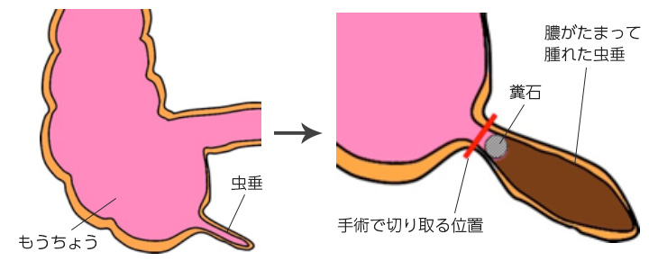 開腹 手術 腹筋