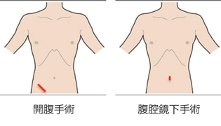 腹筋 開腹 手術