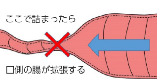 腸閉塞の診断