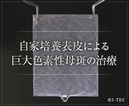 自家培養表皮による巨大色素性母斑の治療