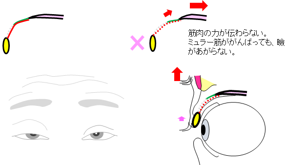 腱膜解離性眼瞼下垂