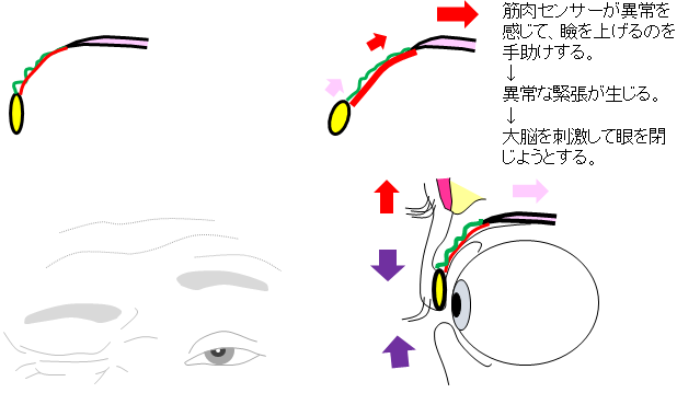 眼瞼痙攣