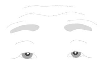 皮膚弛緩性眼瞼下垂