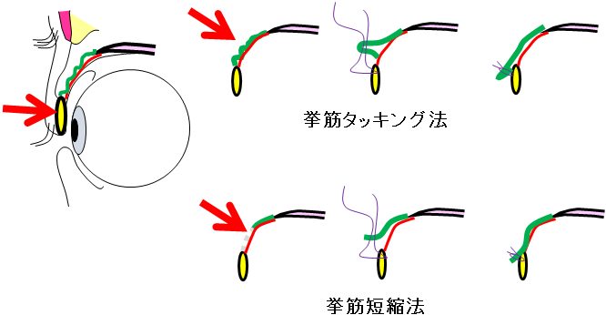 挙筋タッキング法、短縮法