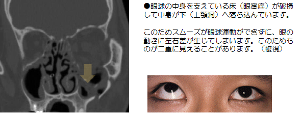 頬骨骨折