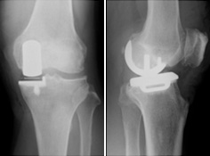 単顆人工膝関節置換術