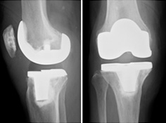 人工膝関節全置換術