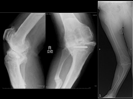 人工膝関節全置換術