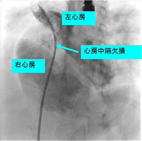 心房中隔欠損