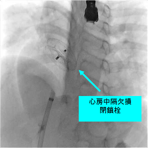 閉鎖栓は切り離され終了