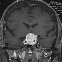 視力障害で発症した非機能性下垂体腺腫、腫瘍が正常下垂体と視神経を強く圧迫している1