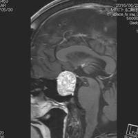 視力障害で発症した非機能性下垂体腺腫、腫瘍が正常下垂体と視神経を強く圧迫している2