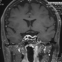 内視鏡下経蝶形骨洞手術により腫瘍が全摘出され、脳下垂体と視神経が見えるようになっている1