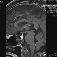 内視鏡下経蝶形骨洞手術により腫瘍が全摘出され、脳下垂体と視神経が見えるようになっている2
