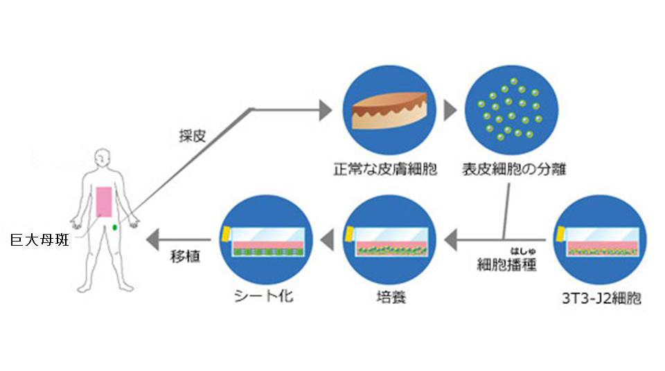 シート化された培養表皮