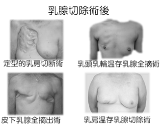 乳腺切除術後