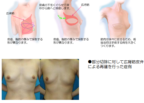 乳がん術後の乳房再建 形成外科 完全予約制 公式 大阪市立総合医療センター