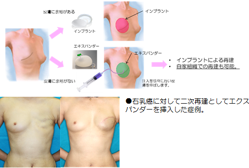 人工乳房（インプラント）による再建