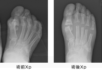 人工足関節置換術