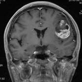 左前頭葉発生の神経膠芽腫を認める、腫瘍は言語野に存在しているため、手術による失語症を来す可能性がある1