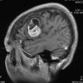 左前頭葉発生の神経膠芽腫を認める、腫瘍は言語野に存在しているため、手術による失語症を来す可能性がある2