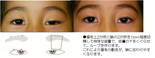 先天性眼瞼下垂 睫毛内反症 逆まつげ 形成外科 完全予約制 公式 大阪市立総合医療センター
