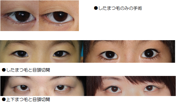 先天性眼瞼下垂 睫毛内反症 逆まつげ 形成外科 完全予約制 大阪市立総合医療センター