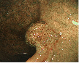 潰瘍性大腸炎関連腫瘍1