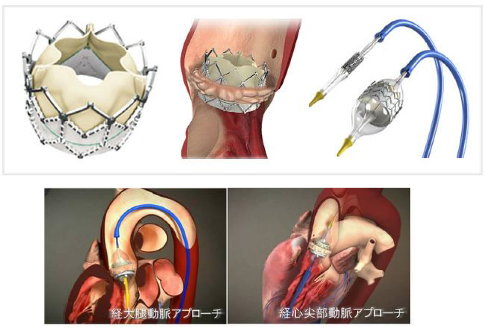 TAVIとは