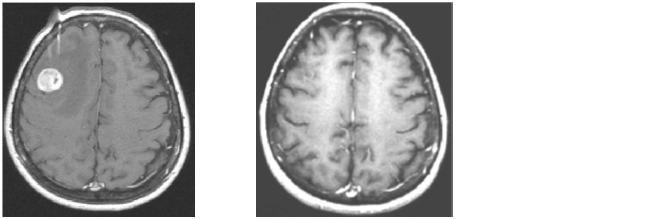 （左）右前頭葉に肺がんの脳転移が認められる。（右）ガンマナイフ治療後6か月経過し、転移性脳腫瘍が完全に消失している。