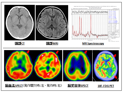 脳画像検査