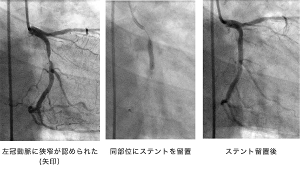 カテーテル治療