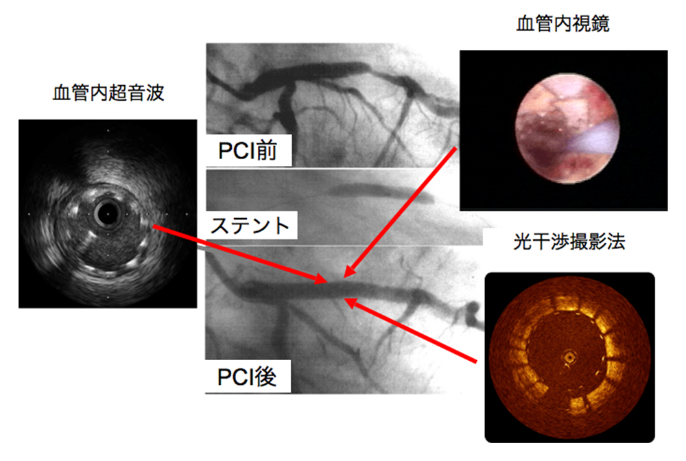 ステントを留置した部位の血管内超音波と光干渉断層法で観察した画像