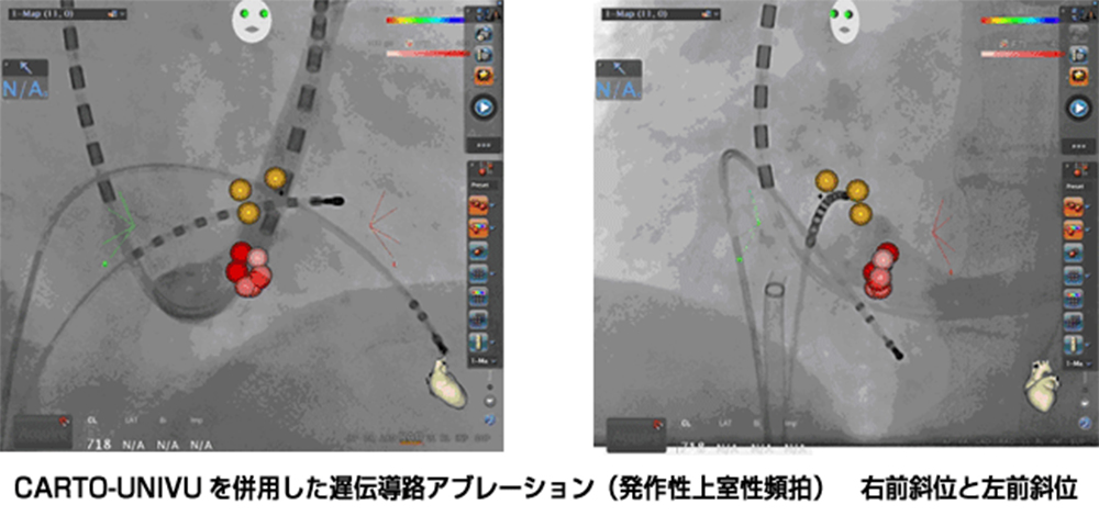 カテーテルアブレーション