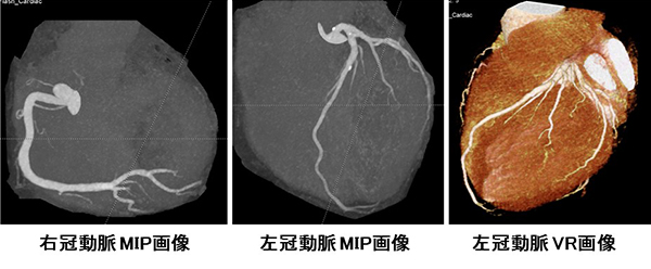 冠動脈CT検査