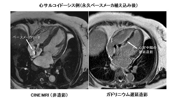 心臓MRI