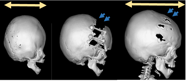 短頭症に対して骨延長法にて頭蓋形成術を施行。術後、骨延長した部分に新しく骨の形成を認め、頭の形のバランスが改善している。（青矢印）