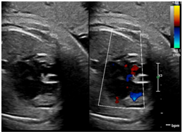 胎児心臓超音波検査写真⑥