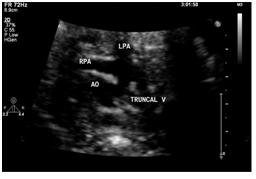 胎児心臓超音波検査写真⑧