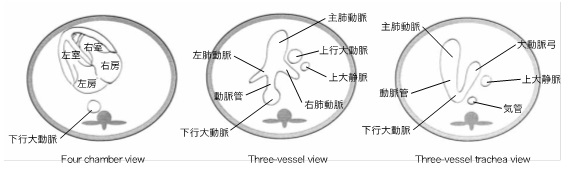 胎児心臓超音波検査画像④