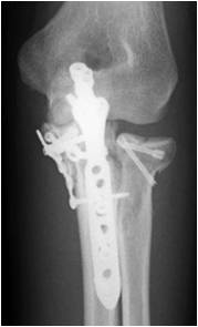 肘の複雑な骨折に対するプレート、スクリューによる骨接合術