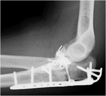 肘の複雑な骨折に田うするプレート、スクリューによる骨接合術