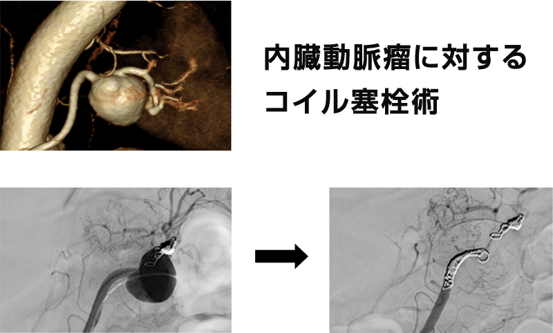 血管内治療1