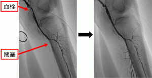 血管内治療2
