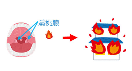 ｉｇａ腎症 腎臓 高血圧内科 公式 大阪市立総合医療センター