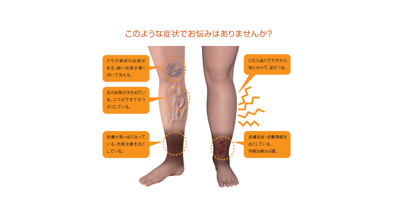 下肢静脈瘤 心臓血管外科 公式 大阪市立総合医療センター