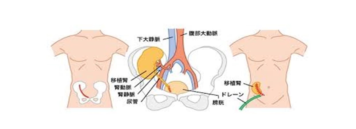 腎移植③1