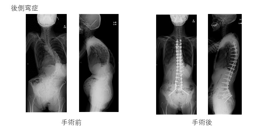 後側弯症手術