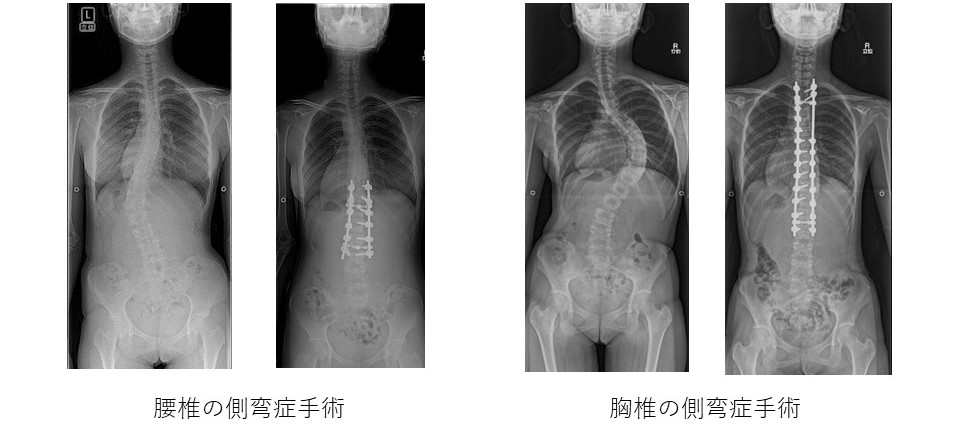 側弯症手術