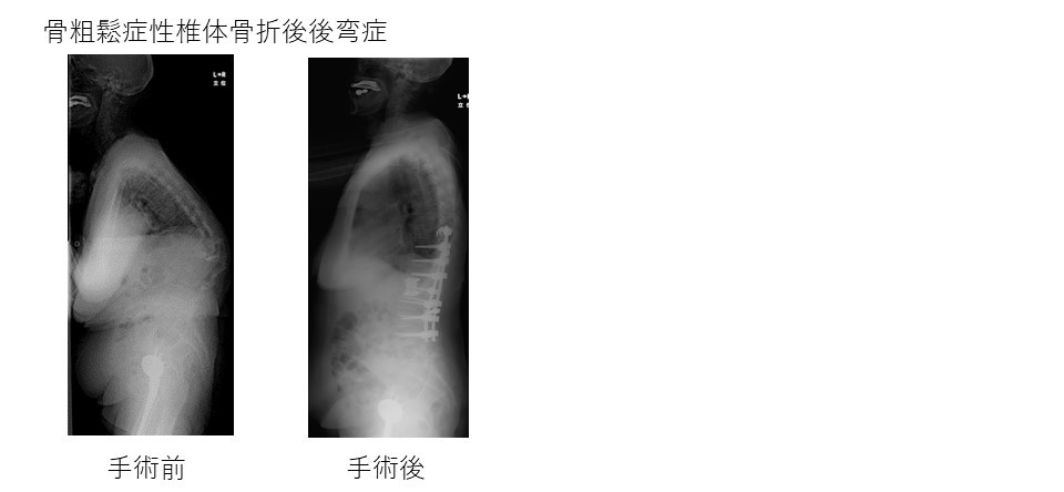 骨粗鬆症椎体骨折手術2